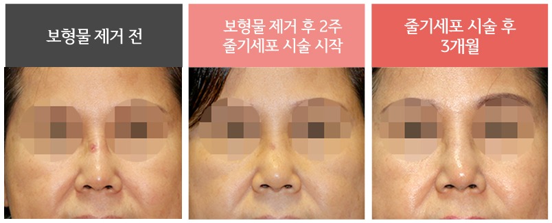 복합적인 원인의 코재수술 사례 07 사진 2 - 리숨성형외과