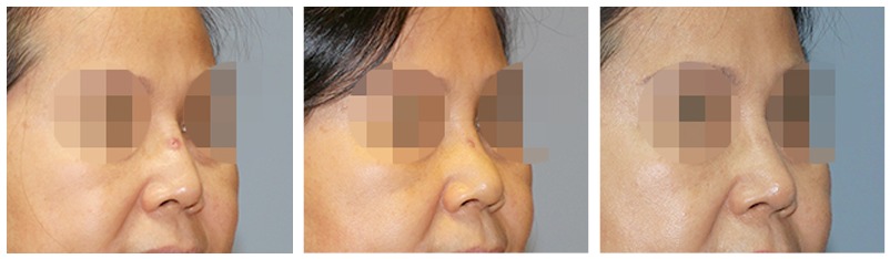 복합적인 원인의 코재수술 사례 07 사진 4 - 리숨성형외과