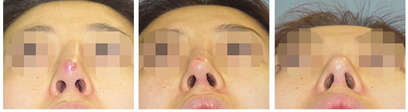 복합적인 원인의 코재수술 사례 08 사진 3 - 리숨성형외과