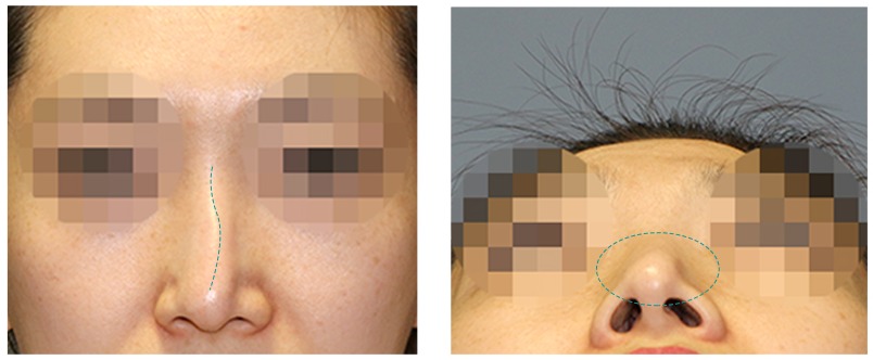 복합적인 원인의 코재수술 사례 15 사진 1 - 리숨성형외과