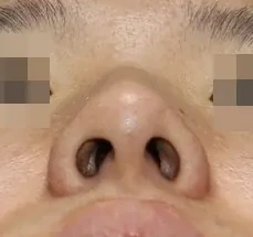 코끝 날개연골 기저면