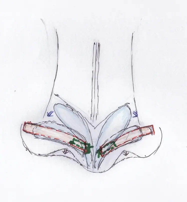 B. Notching 교정 원리