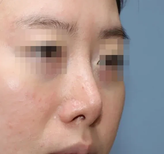 코끝 날개이식 임상 사진