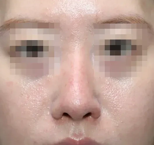 코끝 날개이식 임상 사진