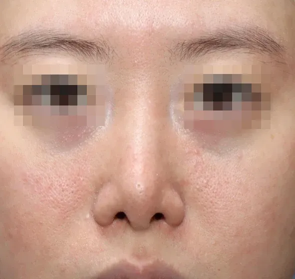 코끝 날개이식 임상 사진