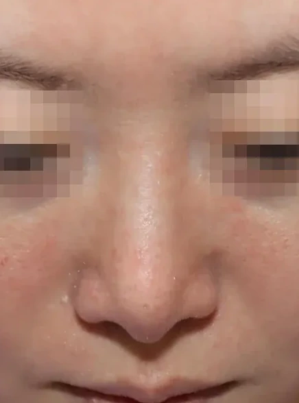코끝 날개이식 임상 사진