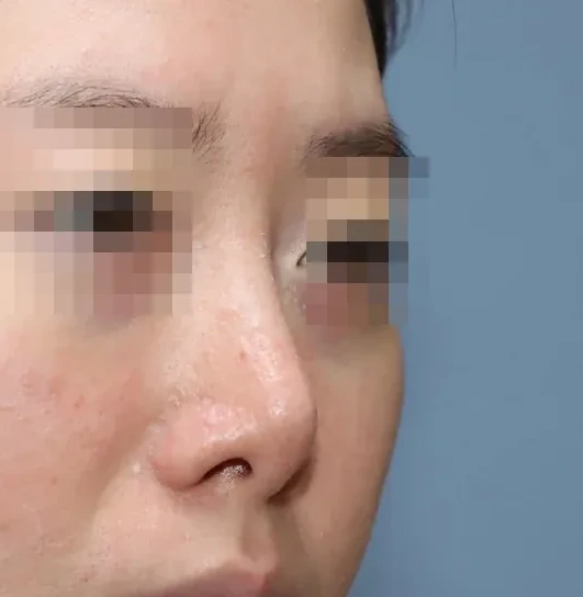 코끝 날개이식 임상 사진