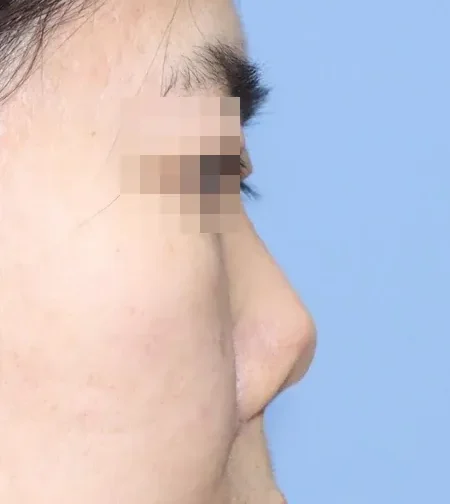 코끝 날개이식 임상 사진