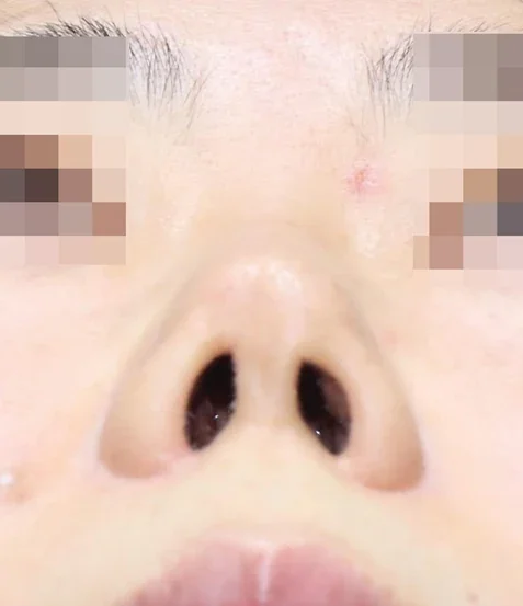 코끝 날개이식 임상 사진
