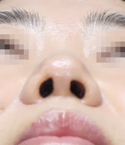 코끝 날개이식 임상 사진