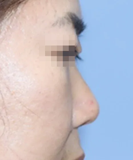 코끝 날개이식 임상 사진