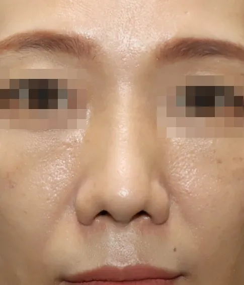 코끝 날개이식 임상 사진