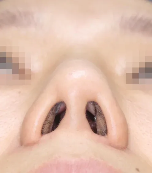 코끝 날개이식 임상 사진