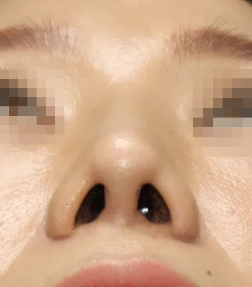 코끝 날개이식 임상 사진