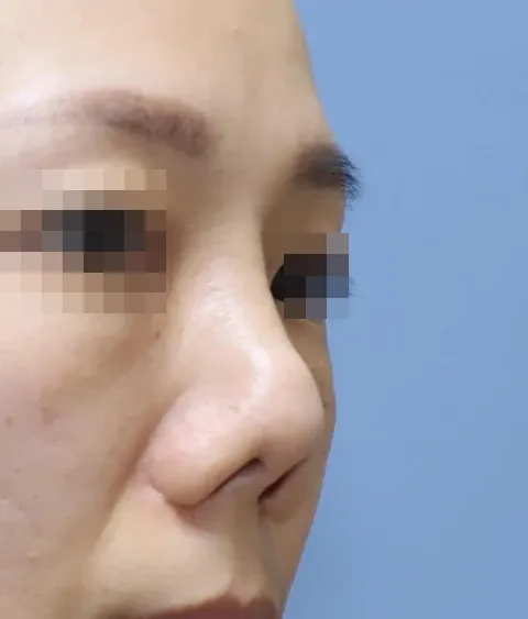 코끝 날개이식 임상 사진