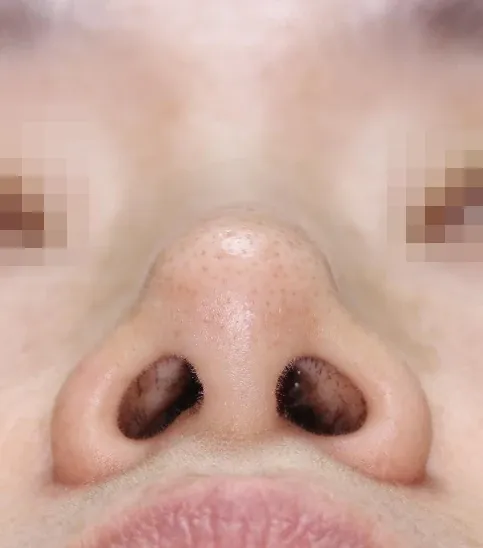 코끝 날개이식 임상 사진