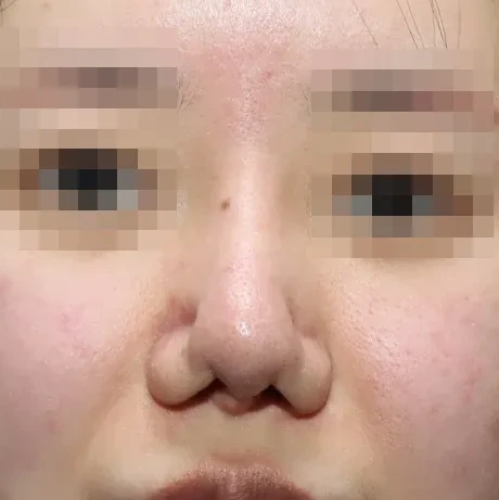 코끝 날개이식 임상 사진