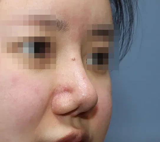 코끝 날개이식 임상 사진