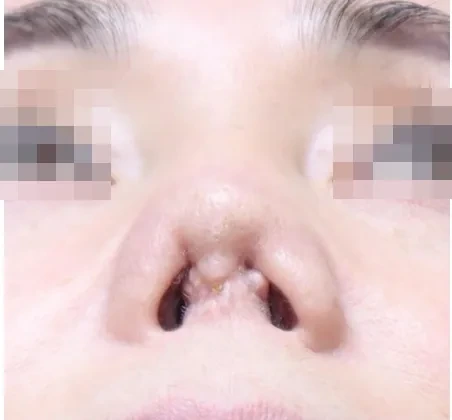 줄기세포 코성형 사진
