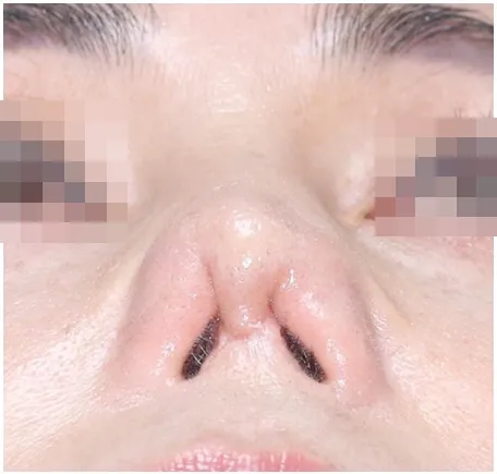 제거 후 1달
