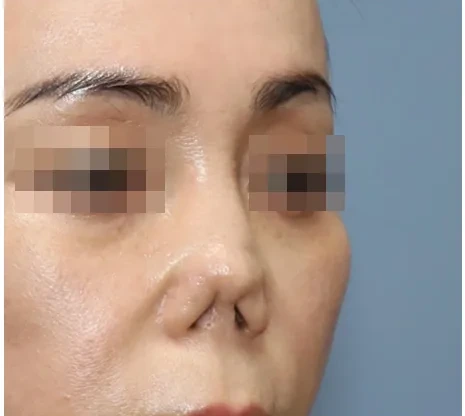 제거 전