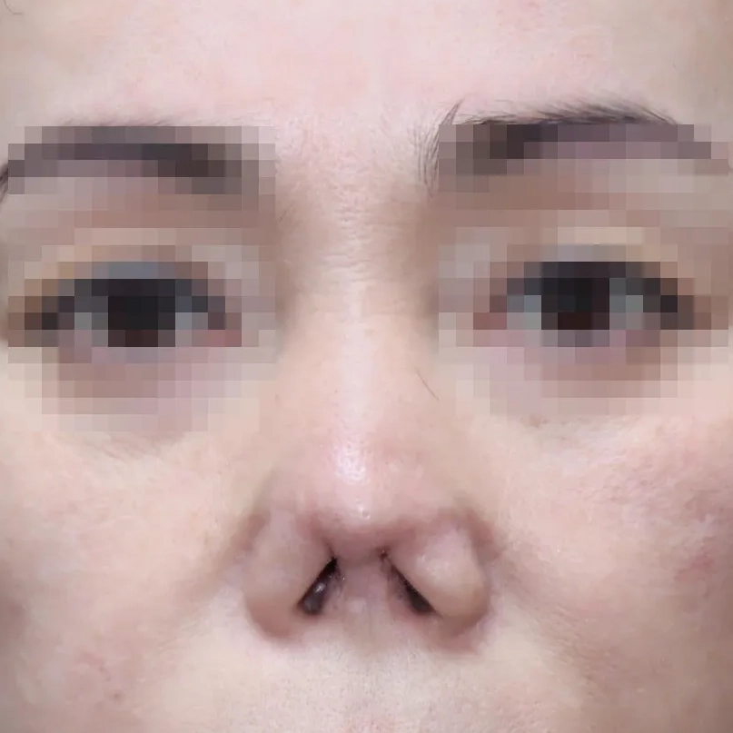 수술 전