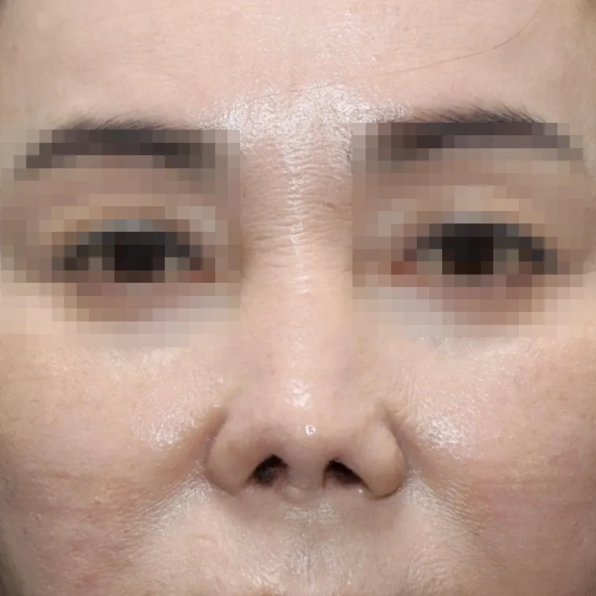 재건 수술 후 10개월