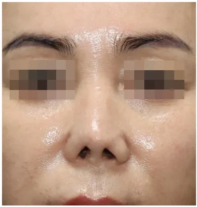 1차 재건 수술 후 3개월