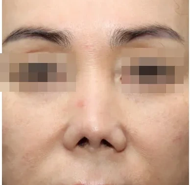 1차 재건수술 후 8개월
