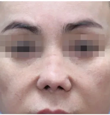 1차 재건수술 후 2년