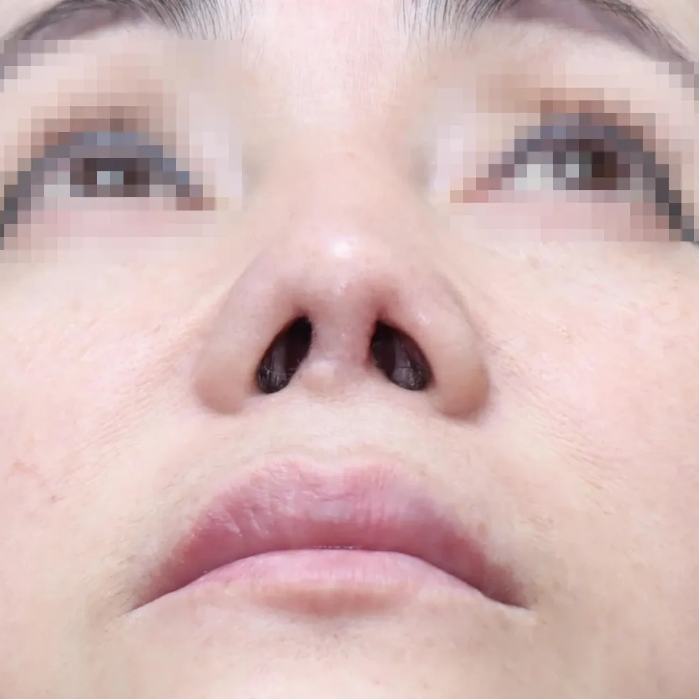 1차 재건 수술 후 3개월