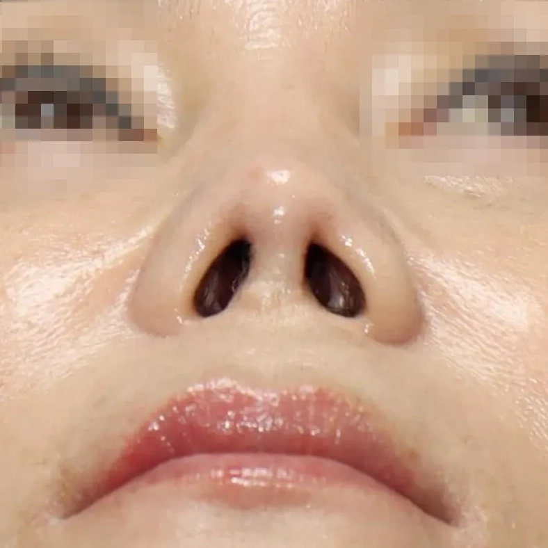 1차 재건수술 후 8개월