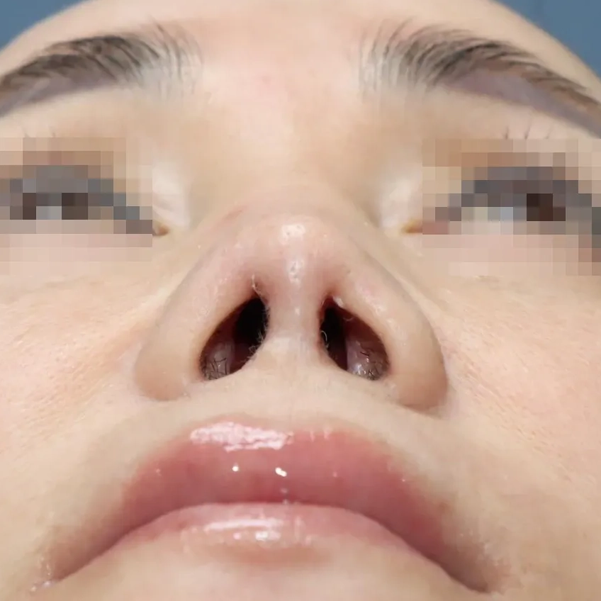 1차 재건수술 후 2년