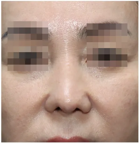 수술 후 5개월