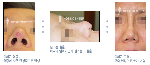 실리콘 코 보형물, 어떤 부작용이 생길까?