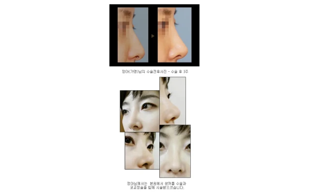 정아님의 코성형전후사진~*