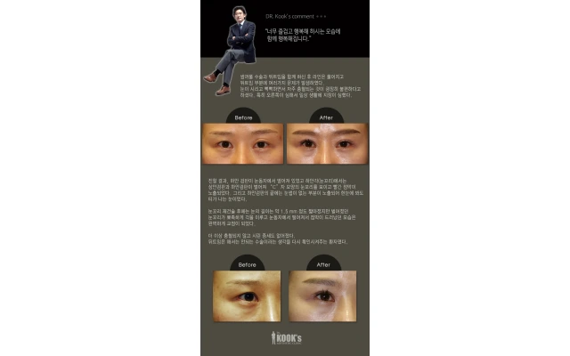 뒤트임 재건, 눈재수술