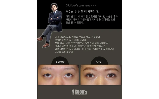 비절개 안검하수 재수술