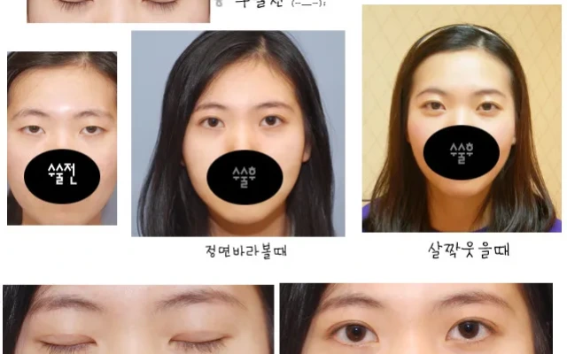 지혜님의 쌍꺼풀 전후사진입니다.