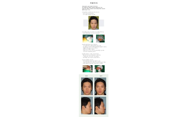 이마 지방이식 수술 과정과 결과
