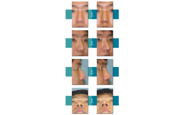 코끝 성형