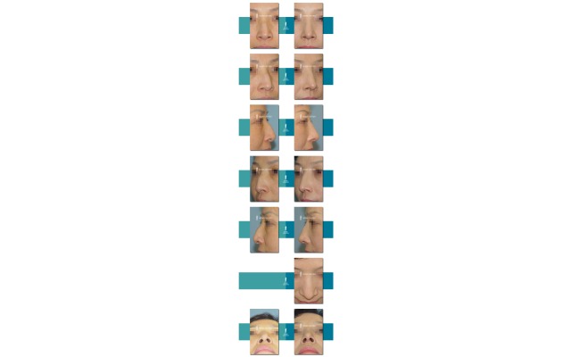 심하게 휘어지고, 매부리코가 동반됨.