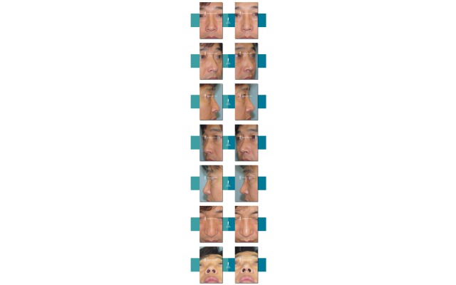 휜코 (reverse \"C shape\")와 매부리가 함께 있음. 코구멍도
