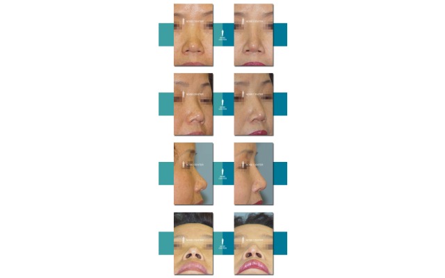 코등이 넓고 낮으며, 코끝도 벌렁하여..