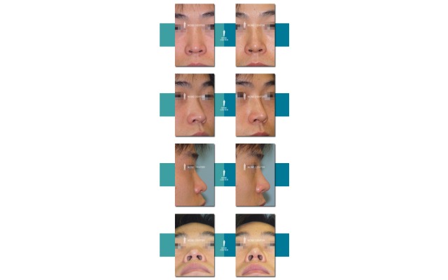 코등이 넓고 코끝은 벌렁하게 퍼져서..