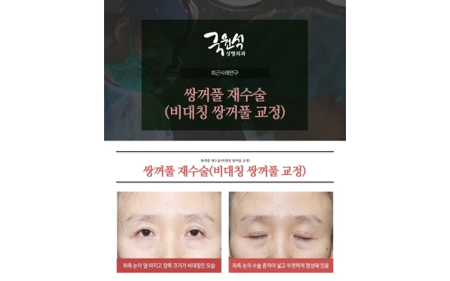 쌍꺼풀 재수술(비대칭 쌍꺼풀 교정) 사례