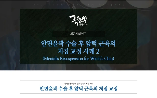 안면윤곽 수술 후 앞턱 근육의 처짐 교정 사례 2