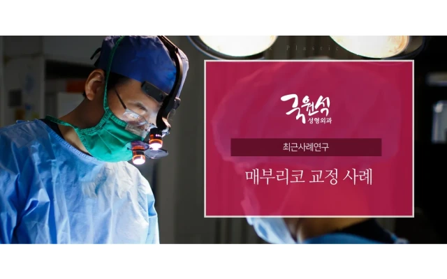매부리코 교정 사례  Hump nose case