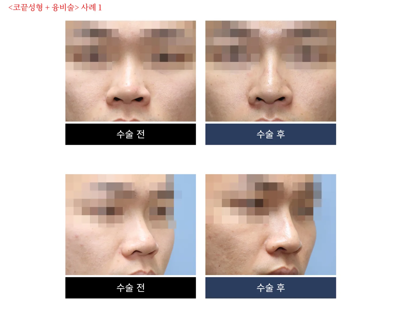 첫 코 성형 - 리숨