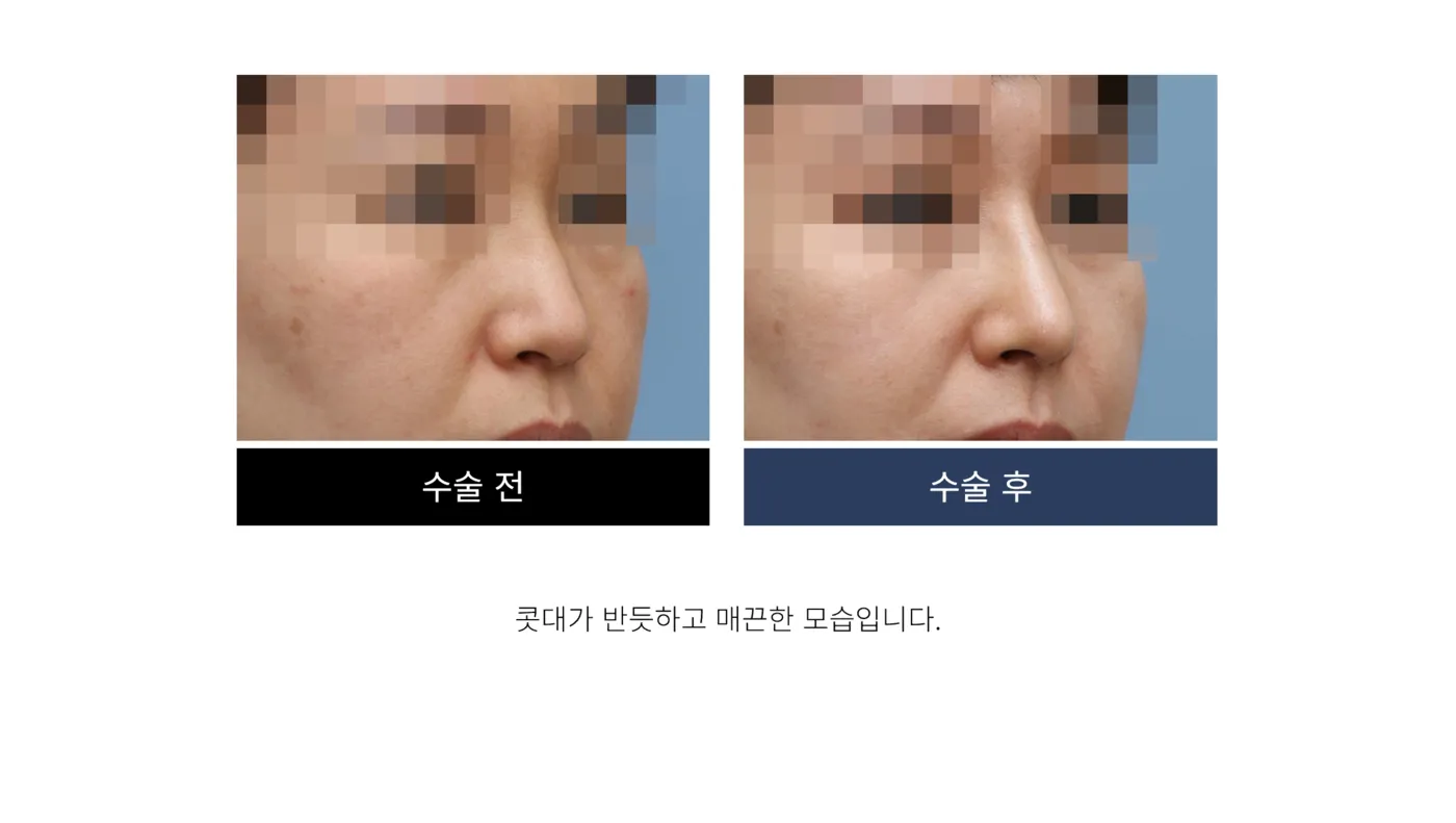 첫 코 성형 - 리숨